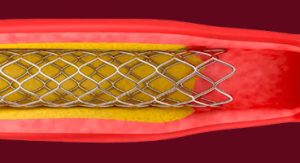 Stent inspection