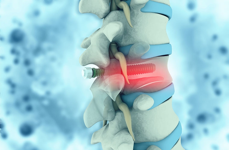 Qualitätskontrolle bei der Herstellung medizinischer Implantate