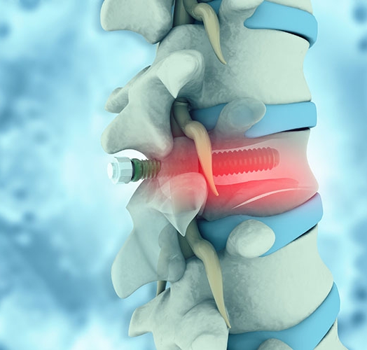 Qualitätskontrolle bei der Herstellung medizinischer Implantate