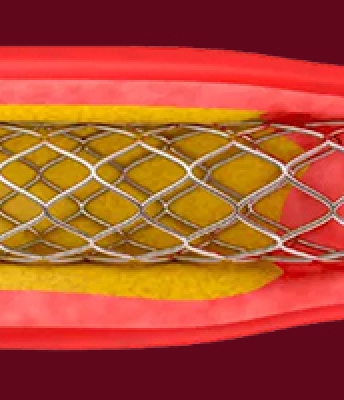 Inspection of stents