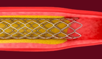 Inspection of stents