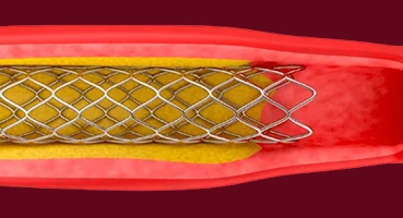 Inspection of stents